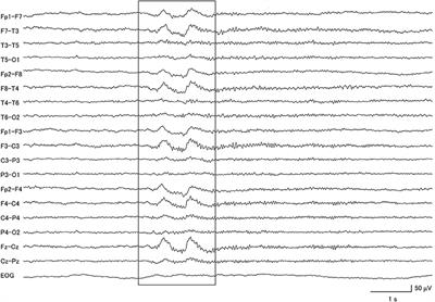 Grand Total EEG Score Can Differentiate Parkinson's Disease From Parkinson-Related Disorders